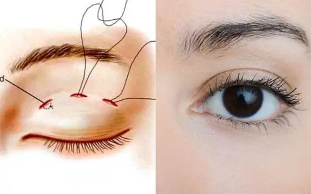 Nhấn mí mắt sau khoảng 1 tháng sẽ lành hẳn