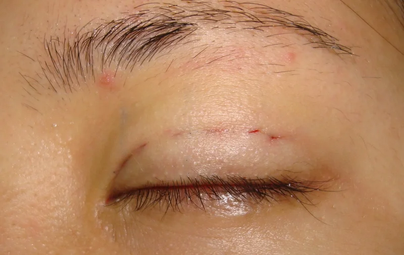 Sau nhấn mí khoảng 7-10 ngày có thể quay lại hoạt động bình thường