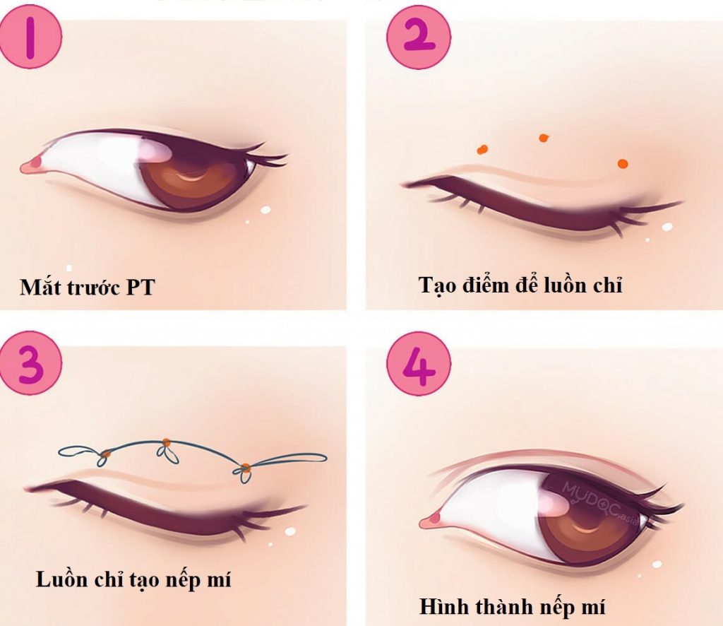 Sau nhấn mí mắt cần thời gian để hồi phục