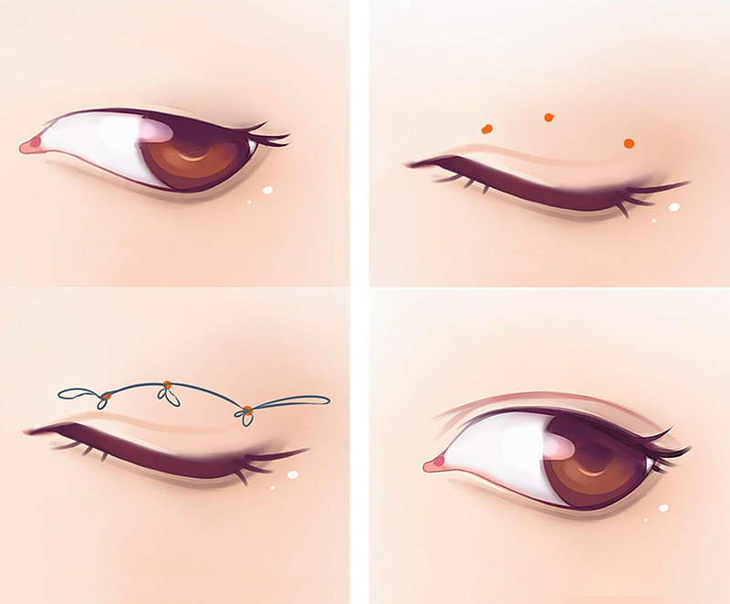 Sau cắt mí, nếu muốn nhấn mí cần chuẩn bị kỹ lưỡng