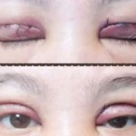 Sau 45 tuổi vẫn có thể cắt mí được, nhưng tùy vào tình trạng mí mắt