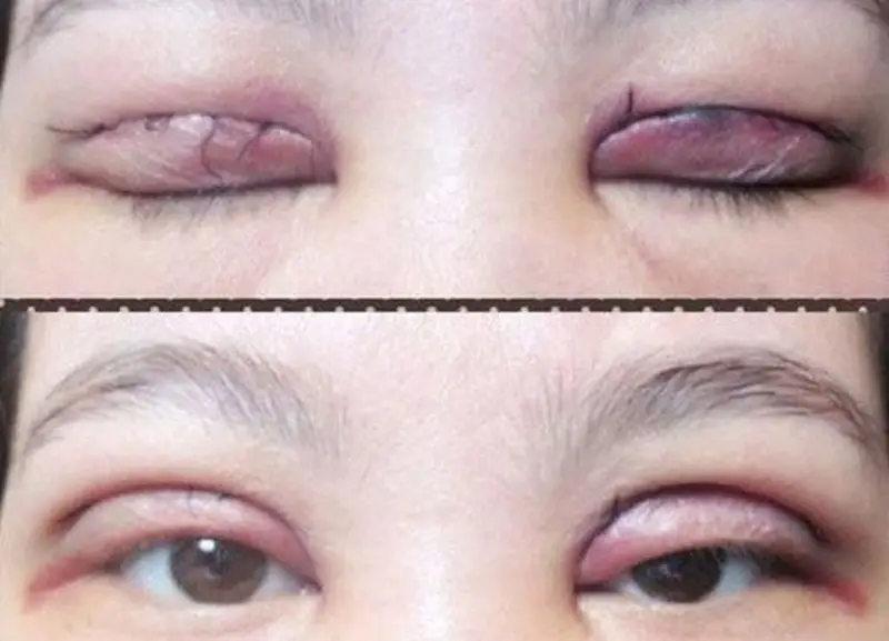 Sau 45 tuổi vẫn có thể cắt mí được, nhưng tùy vào tình trạng mí mắt