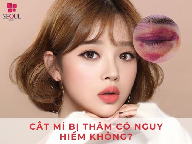 Cắt mí xong mắt bị thâm không có nguy hiểm đến sức khỏe của khách hàng