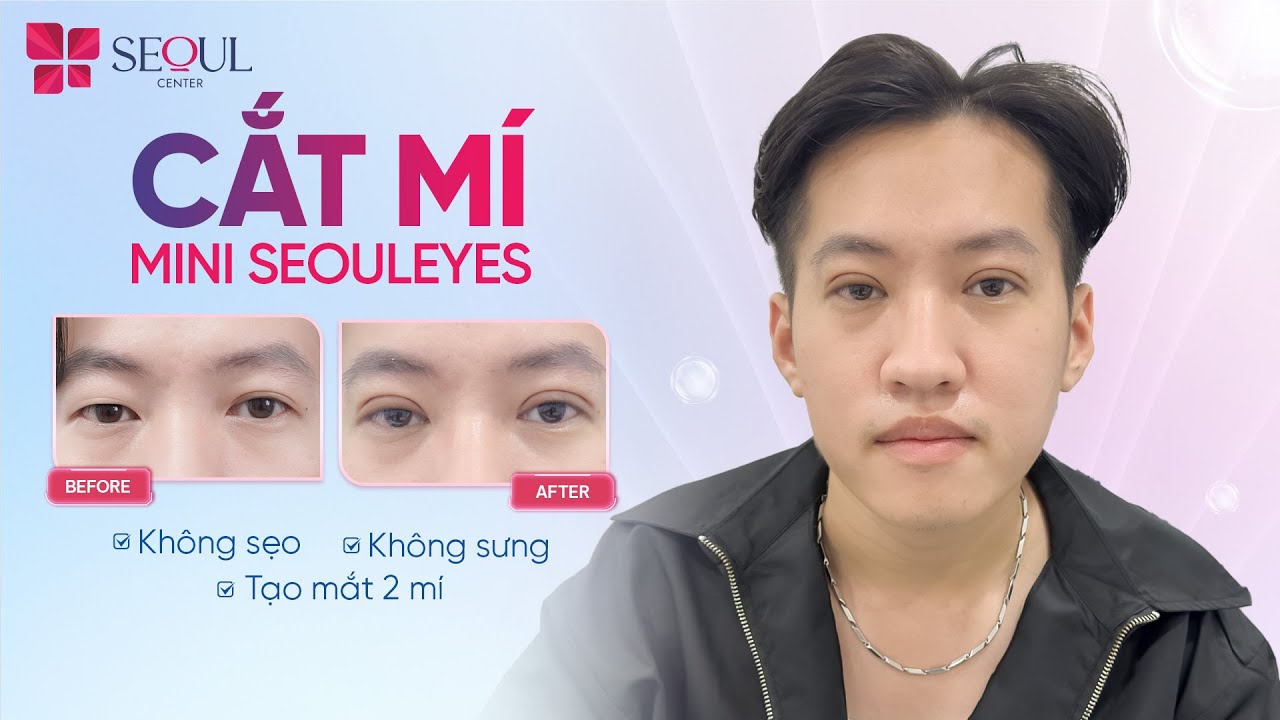Cắt Mí Nam Chuẩn Hàn Không Sưng Không Để Sẹo