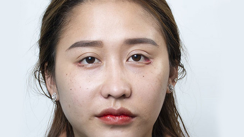 Mí mắt không đều nhau là gương mặt thiếu tự nhiên