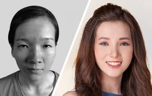 Cắt mí mắt giá bao nhiêu