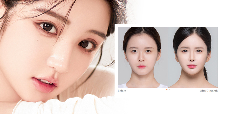 Cắt mí cánh tiên sở hữu nhiều ưu điểm nổi bật được nhiều chị em lựa chọn