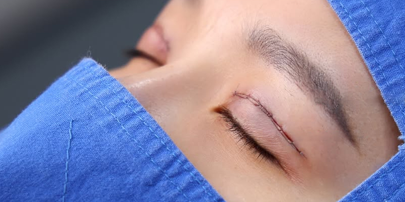 Sau cắt chỉ nên có phương pháp chăm sóc phù hợp để tránh biến chứng
