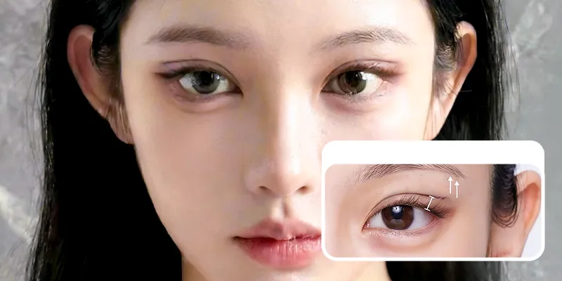 Cắt mí cánh tiên tuy là kỹ thuật khá mới nhưng lại được ưa chuộng
