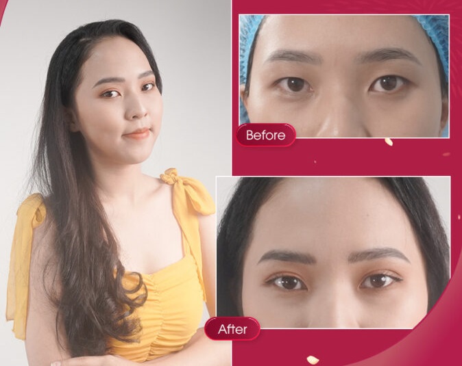 Cắt mí sau khoảng 1-2 tuần có thể ăn nước tương bình thường
