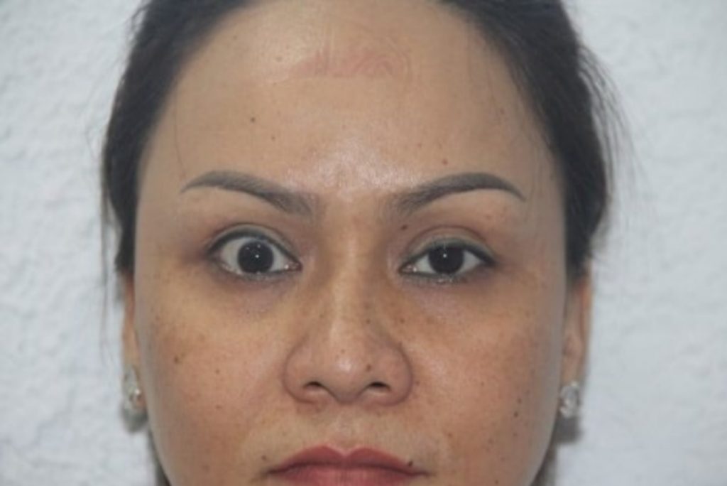 Cắt mí mắt bị trợn thường do nhiều nguyên nhân gây ra