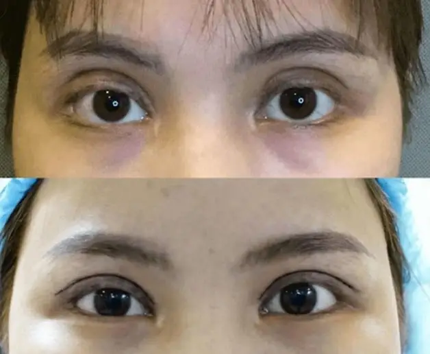 Cắt mí mắt bị trợn có thể khắc phục được tại nhà, nhưng nếu quan trọng cần gặp bác sĩ