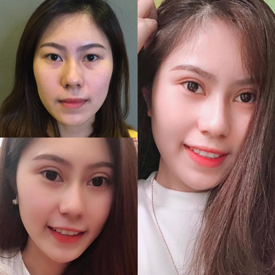 Cắt mí giúp khuôn mặt trông cuốn hút và rạng rỡ hơn