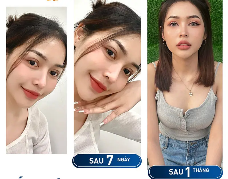 Cần có phương pháp chăm sóc phù hợp theo chỉ dẫn của bác sĩ để mí mắt vào nếp như ý