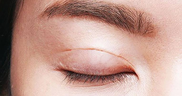 Sẹo trắng hình thành do sự gia tăng sắc tố collagen trong quá trình hồi phục