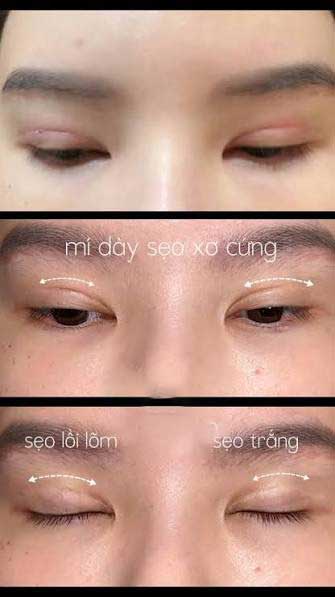 Cần có chế độ chăm sóc và kiêng khem đúng cách để không bị tình trạng seo trắng sau thẩm mỹ