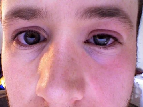 warm compress eyelid surgery care