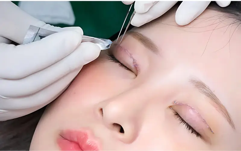 Cả cắt mí và bấm mí đều có những ưu nhược điểm riêng