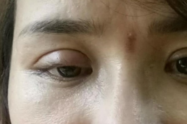 Cắt mí tại cơ sở thiếu uy tín có thể để lại một số tác hại nghiêm trọng