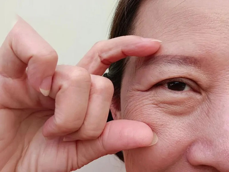 Nhận diện đối tượng phù hợp và chế độ chăm sóc hậu phẫu khoa học giúp nếp mí mau lành, đẹp chuẩn phom