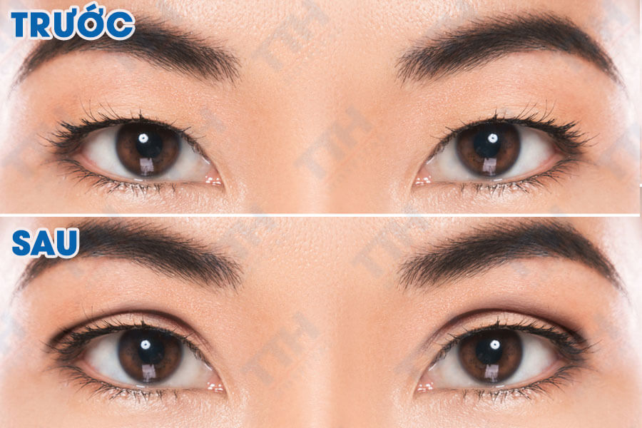 Tuân thủ lịch chườm lạnh, vệ sinh vết thương và kiêng cữ theo chỉ định bác sĩ giúp nếp mí mau lành và vào phom đẹp tự nhiên