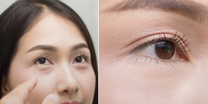 So sánh ưu điểm vượt trội của cắt mí nội soi nhờ khả năng phóng đại vi phẫu, hạn chế tối đa xâm lấn