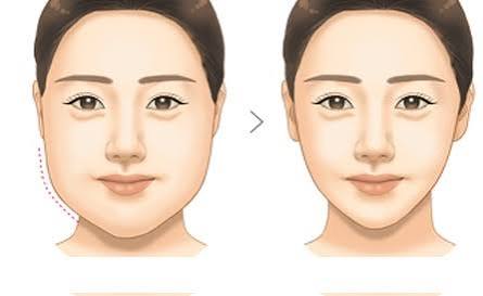 Tại sao mỡ tích ở mặt và cách giảm hiệu quả?