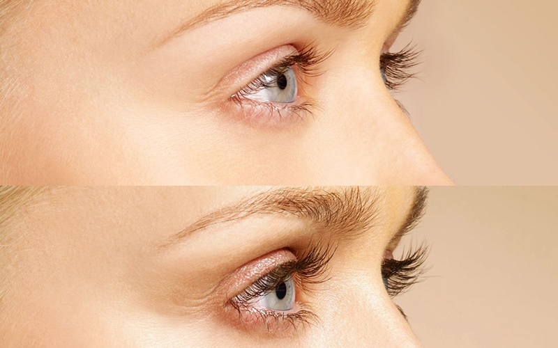 Thẩm mỹ và sức khỏe của đôi mắt chính là hậu quả khi lông mi rụng