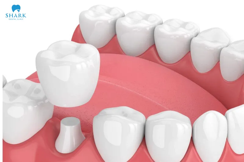 The main advantages of getting a Porcelain Crown include safety, effectiveness, and the restoration of strong chewing function