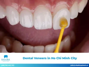Top 10 dental veneers in Ho Chi Minh City, Viet Nam
