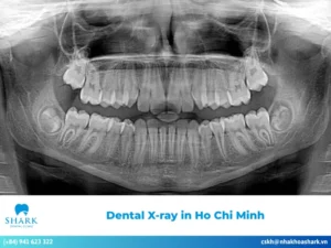 Dental X-ray in Ho Chi Minh