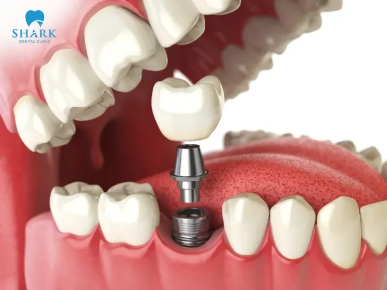 The cost of dental implants in Vietnam currently ranges from 13,000,000 to 35,000,000 VND.
