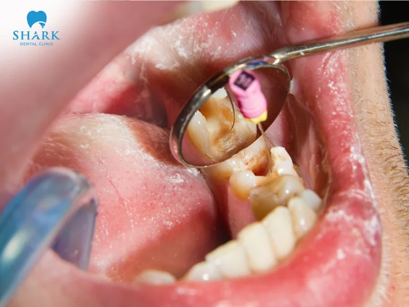 Each dental filling method comes with its own cost, advantages, and disadvantages, allowing patients to choose the option that best suits their needs