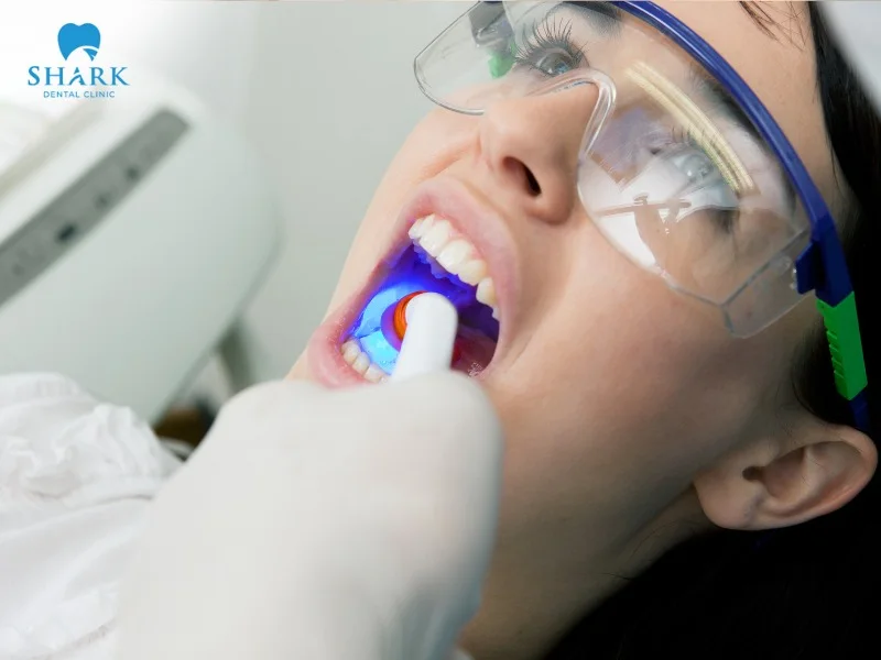 The cost of dental fillings at clinics in Vietnam depends on factors such as oral condition, filling material, and filling technique, etc