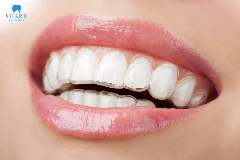 Invisible braces are a highly effective orthodontic treatment method