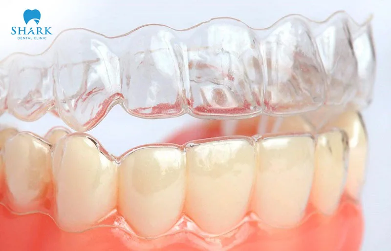 Invisalign braces have invisible braces trays that fit snugly over the teeth