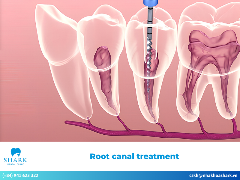 What is Root Canal Treatment