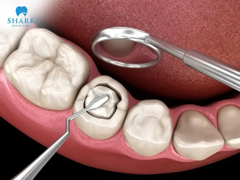 Dental fillings use appropriate dental materials to fill cavities, correct tooth decay and damage.