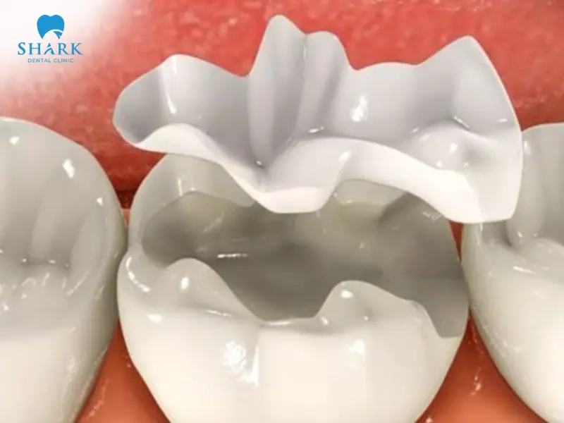 Tooth fillings using composite resin provide excellent aesthetic results, closely matching the natural color of teeth