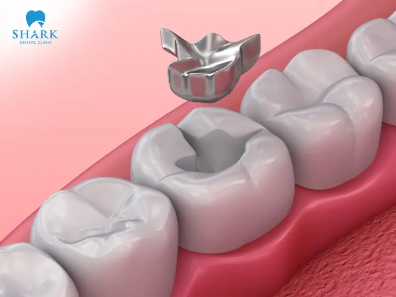 Amalgam (silver) fillings offer excellent durability and a long lifespan