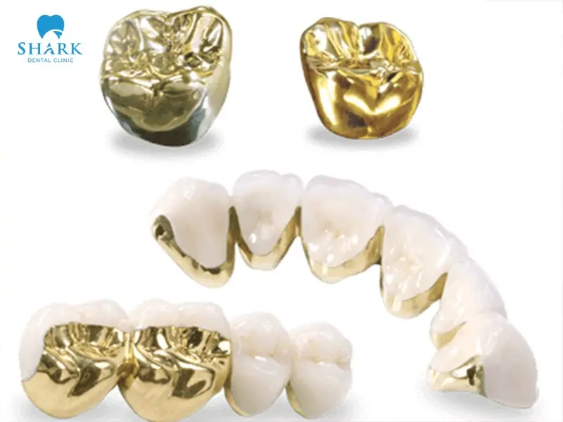 Dental fillings made from gold reflect elegance and prestige, but they are significantly more expensive