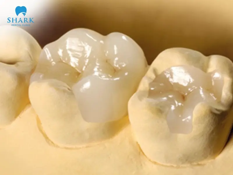 Porcelain fillings are valued for their strong resistance to chewing forces and long-lasting lifespan of up to 10 to 15 years
