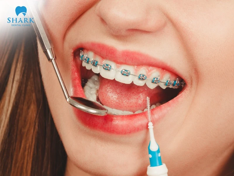 Getting braces in Vietnam due to the effective orthodontic results and affordable cost