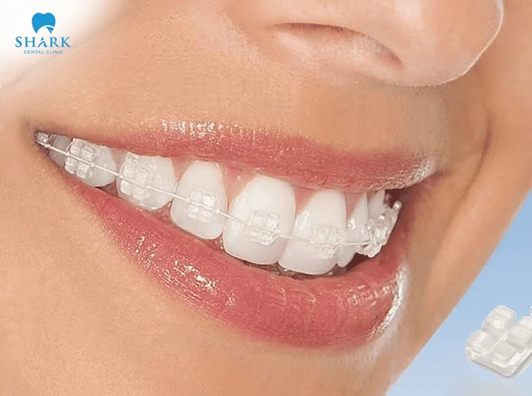 Ceramic braces are safe and highly aesthetic.