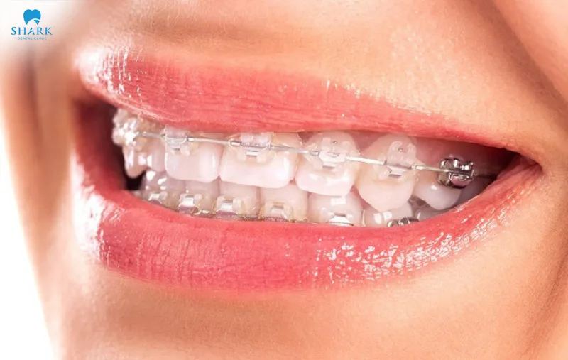 The cost of ceramic braces is relatively higher compared to other orthodontic methods