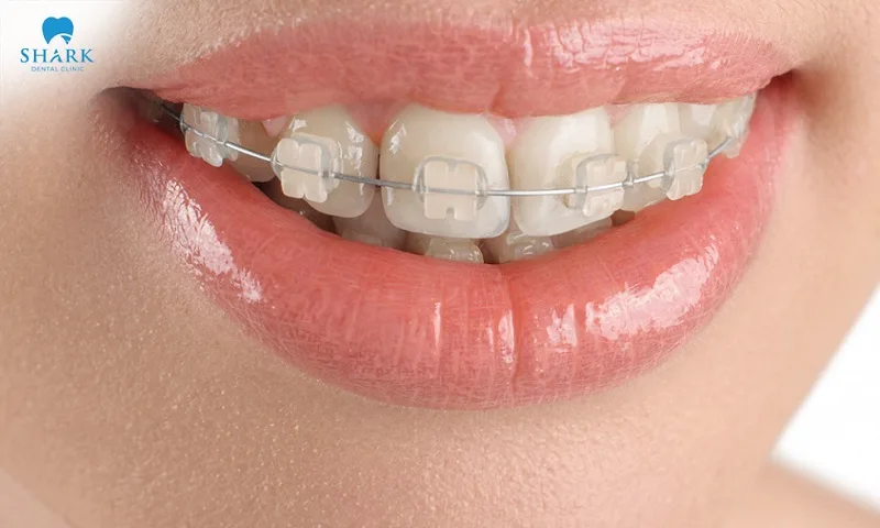 Ceramic braces are suitable for correcting a wide range of dental issues