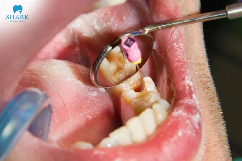 The cost of root canal treatment in Ho Chi Minh City is not too high and is affordable for many people