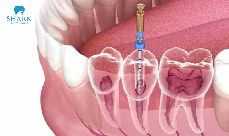 The severity of the tooth infection partly determines the overall treatment cost