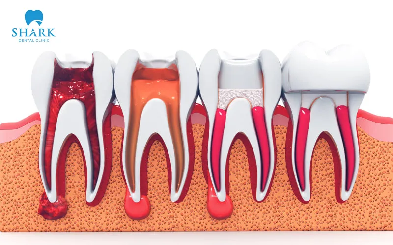 Low-cost root canal treatment carries a high risk of complications and severe reinfection