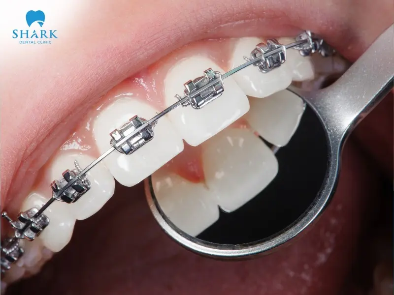 Braces are a method that effectively improves dental aesthetics and helps prevent oral diseases